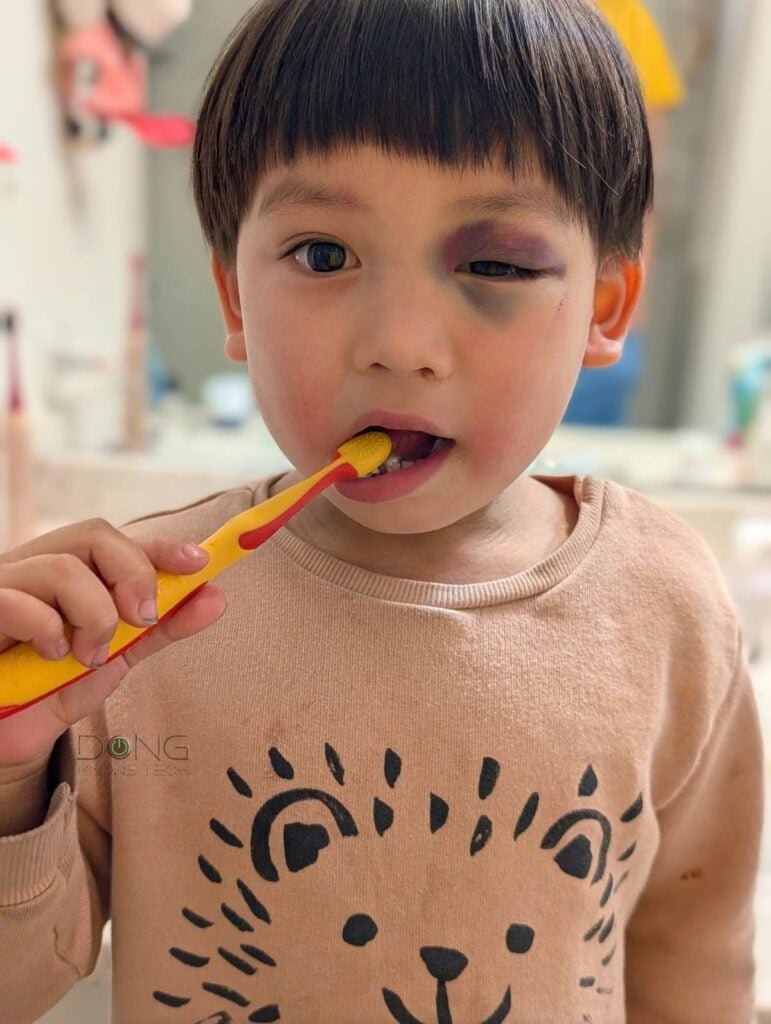 Boy with bruised eye